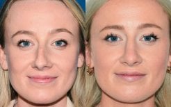 Résultats avant/après rhinoplastie à la clinique Veselibu, remodelage nasal naturel