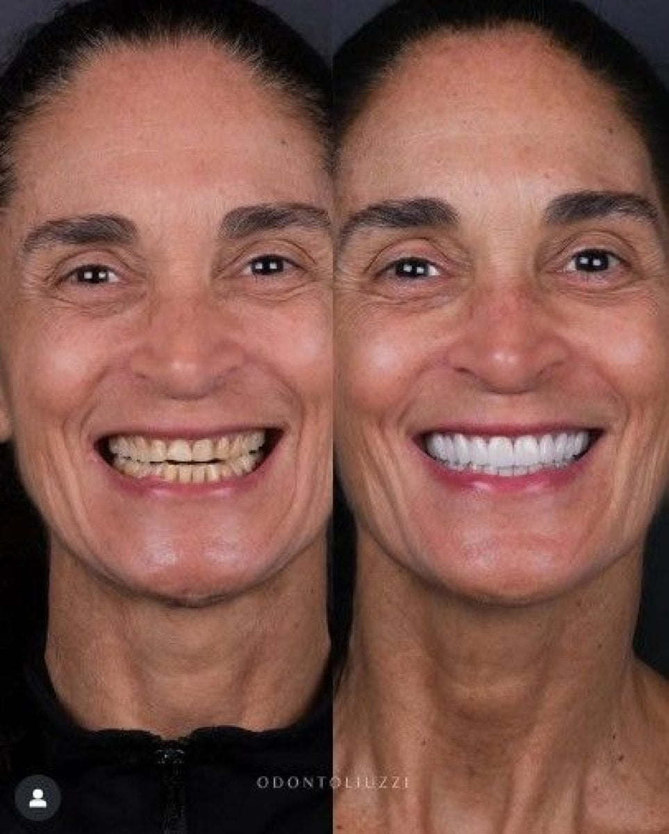 Resultados antes y después de coronas en el día en Odontoliuzzi Dentistry and Health
