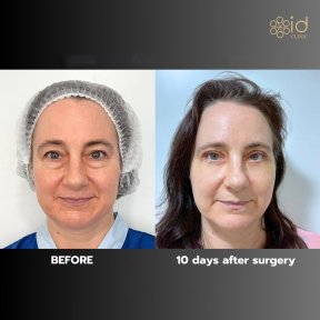 Before and after upper and lower eyelid surgery results at ID Clinic Bangkok, 10 days post-op