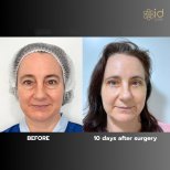 Before and after upper and lower eyelid surgery results at ID Clinic Bangkok, 10 days post-op