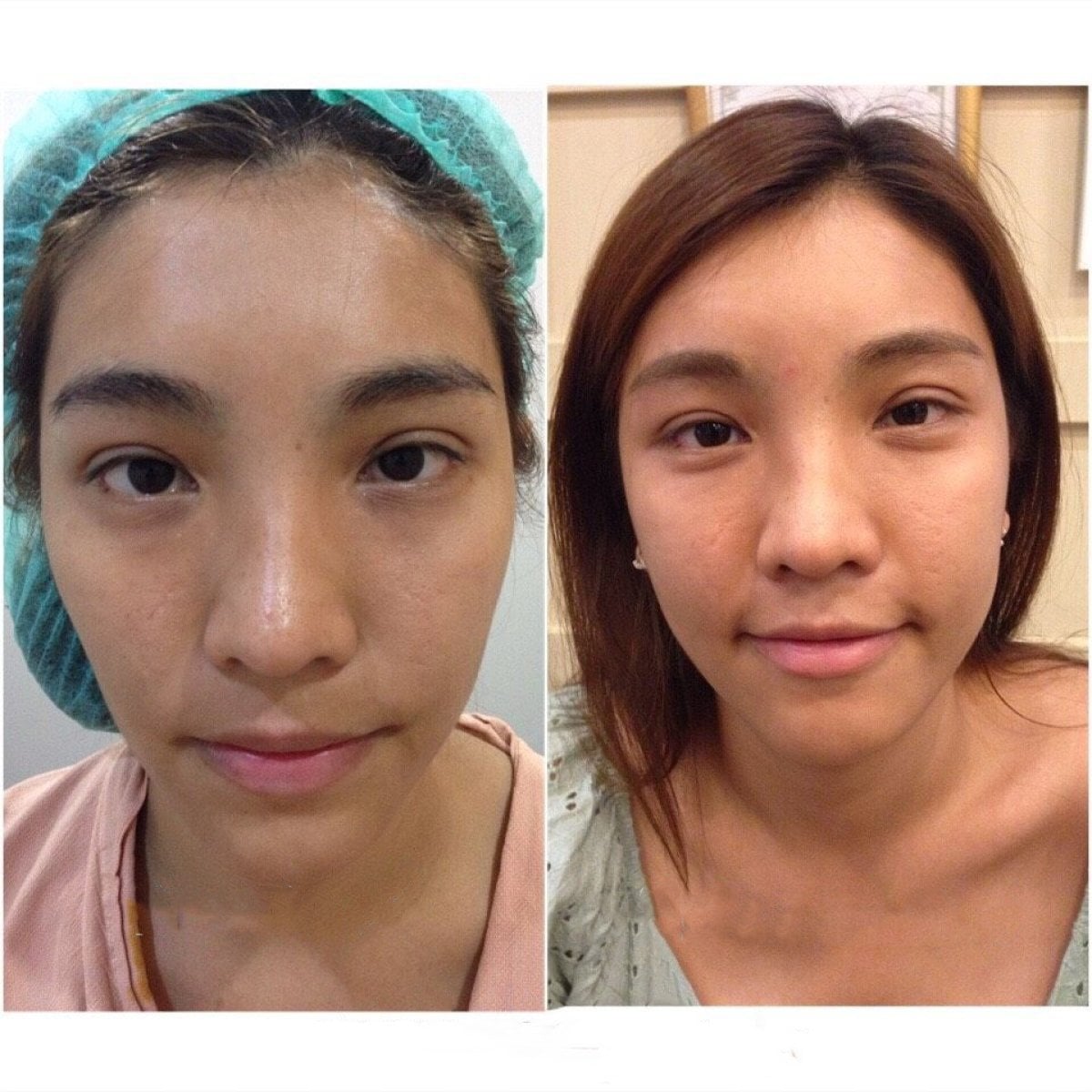 نتائج نقل دهون الوجه قبل وبعد في Asia Cosmetic Hospital، تحسين امتلاء الوجه