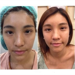 Before and after facial fat transfer results at Asia Cosmetic Hospital, improved facial volume