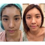Before and after facial fat transfer results at Asia Cosmetic Hospital, improved facial volume