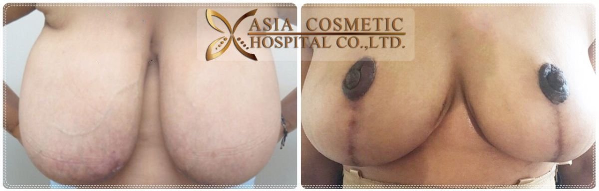 Before and after breast implant removal results at Asia Cosmetic Hospital, improved breast contour