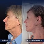 Before and after neck lift results at Dr. Safa Manav Clinic, visible jawline and neck tightening