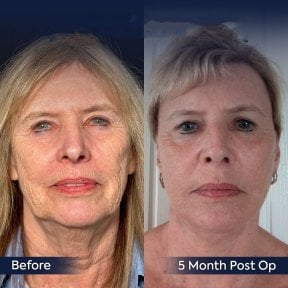 Before and after neck lift results at Dr. Safa Manav Clinic, visible skin tightening effect