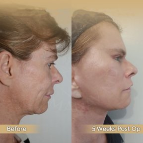 Vorher-nachher-Ergebnis Brauenlifting bei Dr. Safa Manav Clinic, sichtbare Verjüngung