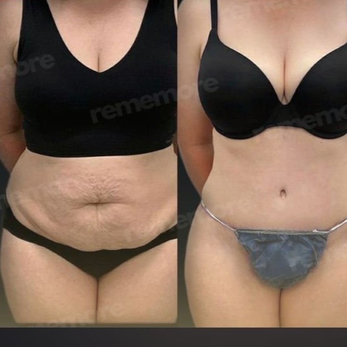 Resultados antes y después de Renuvion J Plasma en Memorial Bahçelievler Hospital, abdomen firme