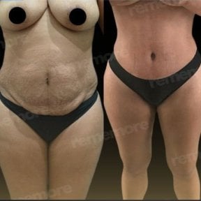 Resultados de abdominoplastia antes y después en Memorial Ankara Hospital, abdomen mejorado