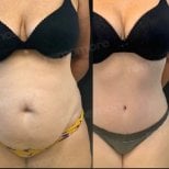 Resultados de abdominoplastia antes y después en Memorial Ankara Hospital, contorno abdominal visible