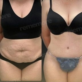 Resultados de abdominoplastia antes y después en Memorial Ankara Hospital, abdomen mejorado
