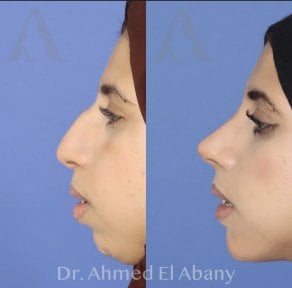 Результаты ринопластики до и после в PyraMedicine, естественный профиль носа