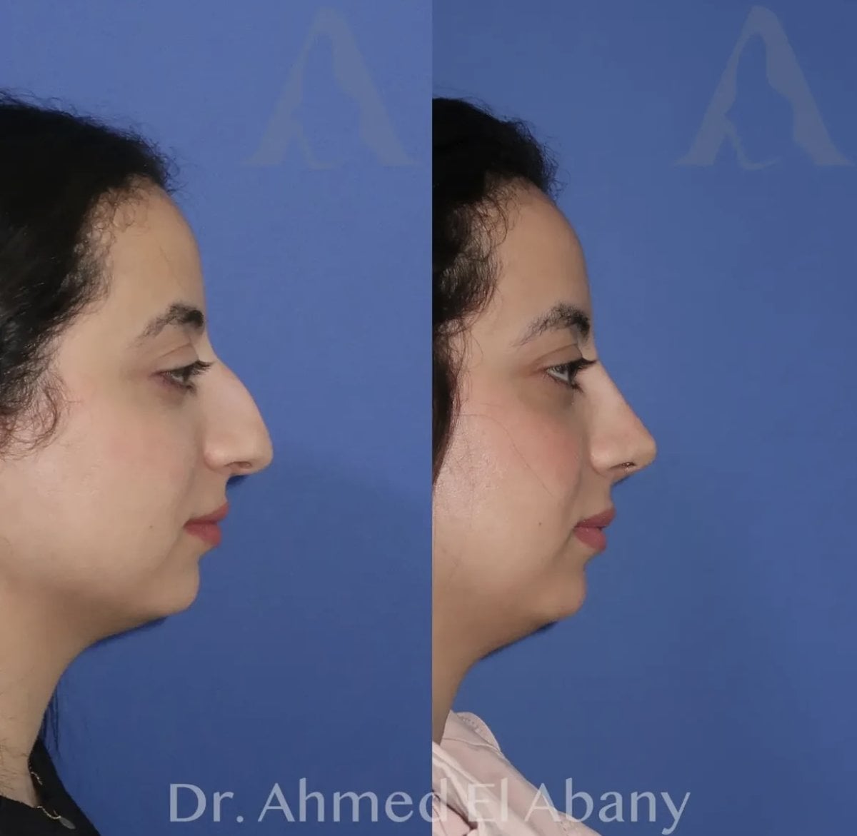 Resultados de rinoplastia antes y después en PyraMedicine, perfil mejorado de la nariz