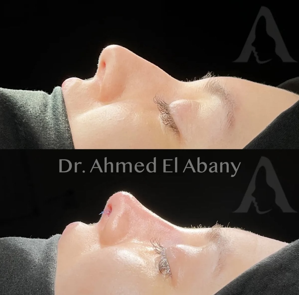 Resultados de rinoplastia antes y después en PyraMedicine, perfil nasal natural