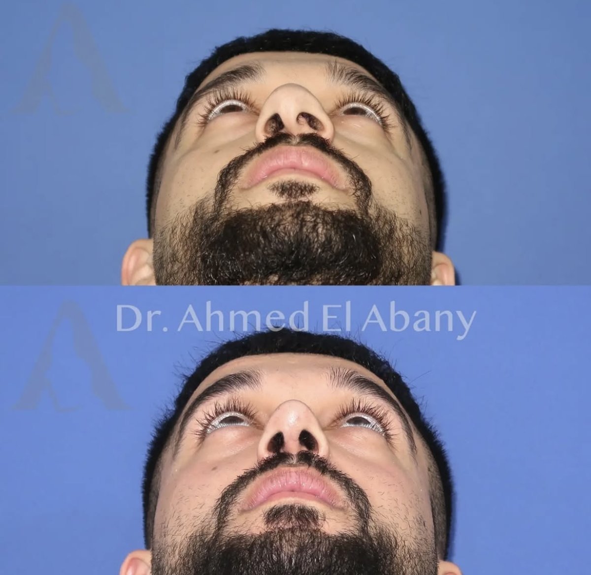 Resultados de rinoplastia antes y después en PyraMedicine, mejor simetría y forma nasal