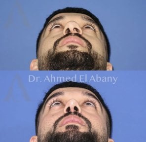 Before and after rhinoplasty results at PyraMedicine, improved nasal symmetry and shape