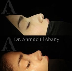 Before and after rhinoplasty results at PyraMedicine, nose reshaping with natural profile