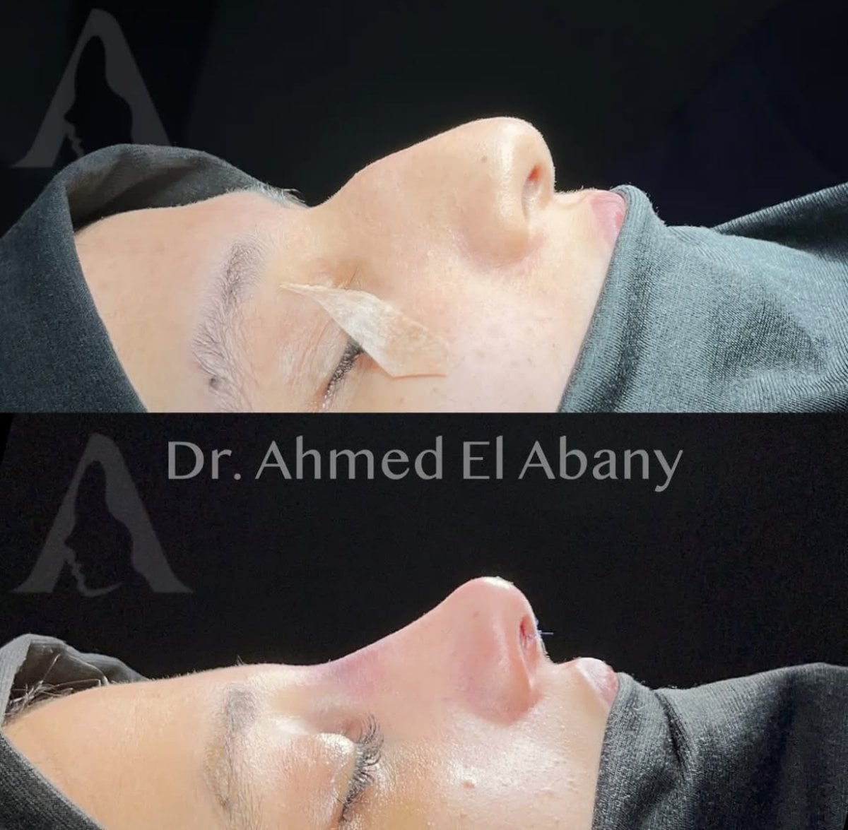 Resultados de rinoplastia antes y después en PyraMedicine, contorno nasal natural