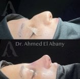 Before and after rhinoplasty results at PyraMedicine, nose reshaping with natural contour