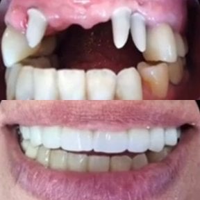 Résultats avant et après pose de couronnes dentaires chez PyraMedicine – sourire restauré