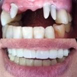 Résultats avant et après pose de couronnes dentaires chez PyraMedicine – sourire restauré