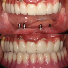 Before and after dental crown installation results at PyraMedicine – improved smile aesthetics