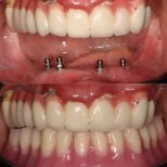 Before and after dental crown installation results at PyraMedicine – improved smile aesthetics