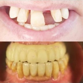 Before and after dental crown installation at PyraMedicine – improved smile restoration result