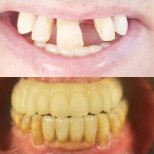 Before and after dental crown installation at PyraMedicine – improved smile restoration result