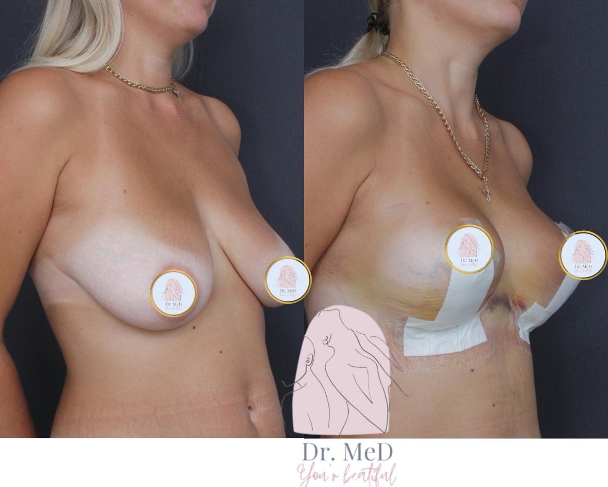 Vorher-nachher-Ergebnis Brustvergrößerung bei Dr. MED, sichtbare Straffung und Form