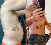 Vorher-nachher-Ergebnis Bodylift bei Liv Hospital Ulus – sichtbare Bauchkontur