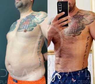 Vorher-nachher-Ergebnis Full Body Lift bei Liv Hospital Ulus, verbesserte Körperkontur