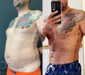 Vorher-nachher-Ergebnis Full Body Lift bei Liv Hospital Ulus, verbesserte Körperkontur