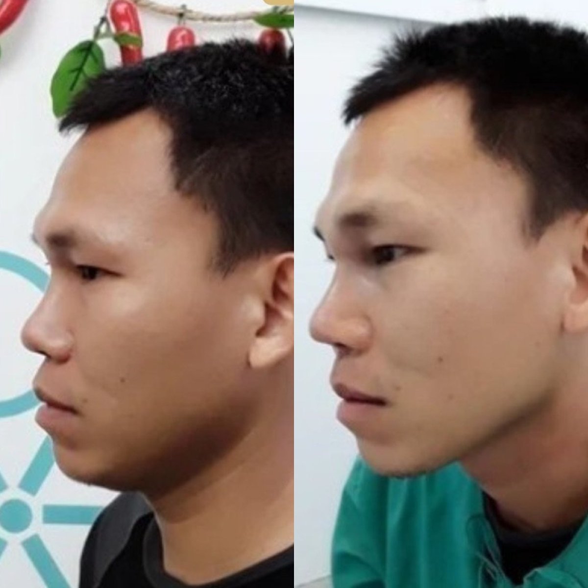 Resultados de rinoplastia antes y después en ID Clinic Bangkok, perfil nasal mejorado en hombre