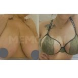 Before and after breast reduction results at Memorial Şişli Hospital, improved breast shape