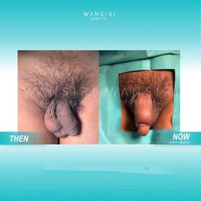 Результати до і після філлерів пеніса у Wansiri Hospital, помітне збільшення об'єму