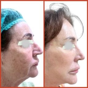 Результати до і після підтяжки обличчя в DGB Clinic – омолодження та підтяжка шкіри