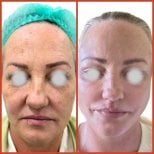 نتائج شد الوجه قبل وبعد في DGB Clinic – تجديد شباب الوجه وبشرة أكثر نعومة