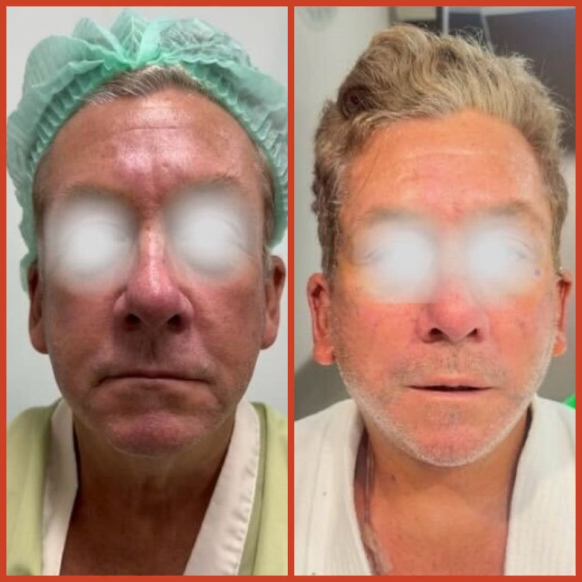 Resultados de lifting facial antes y después en DGB Clinic, rejuvenecimiento visible