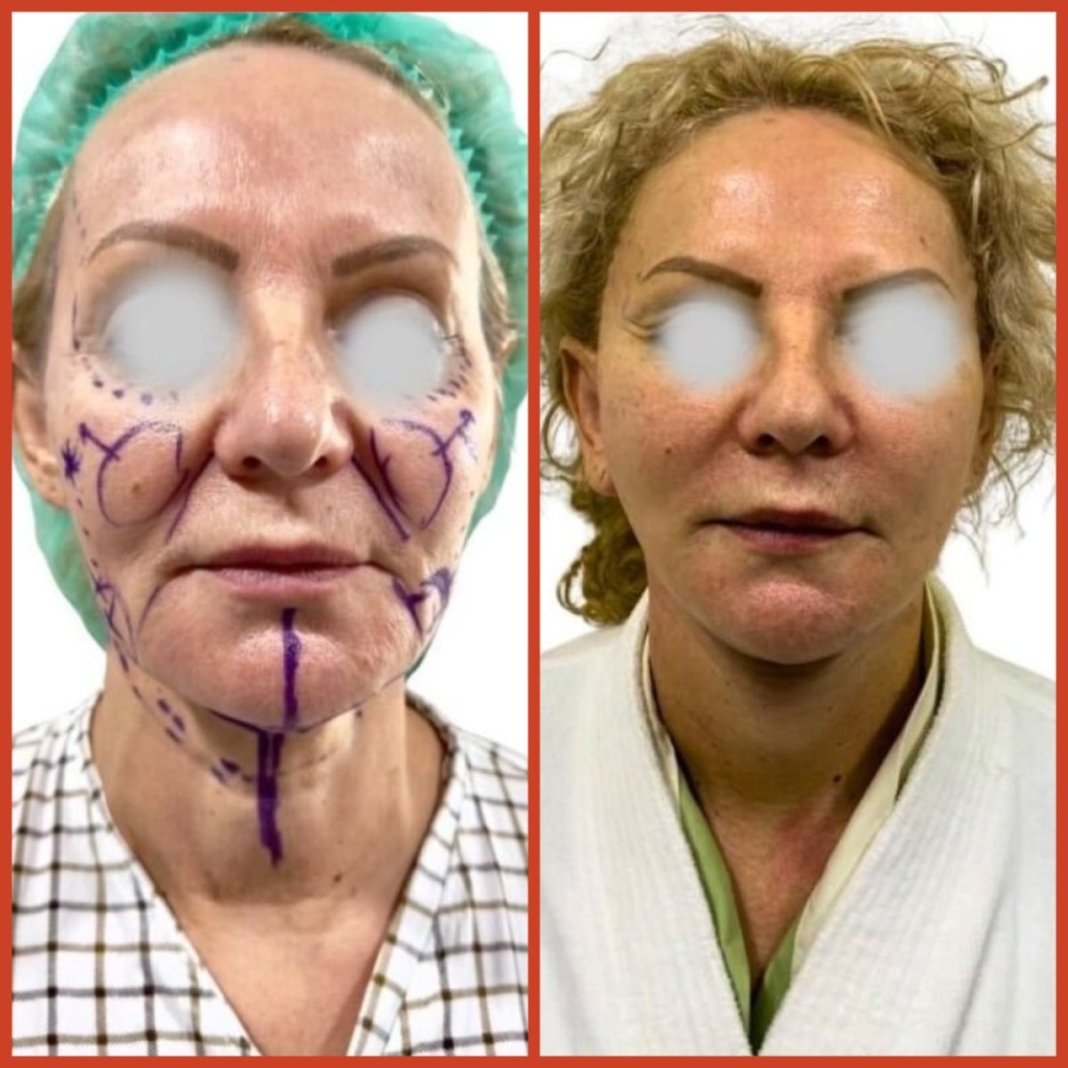 Resultados de lifting facial antes y después en DGB Clinic – rejuvenecimiento visible