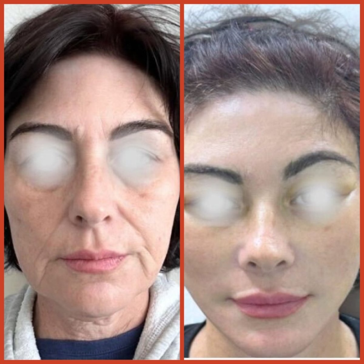 Resultados de lifting facial antes y después en DGB Clinic – rejuvenecimiento visible