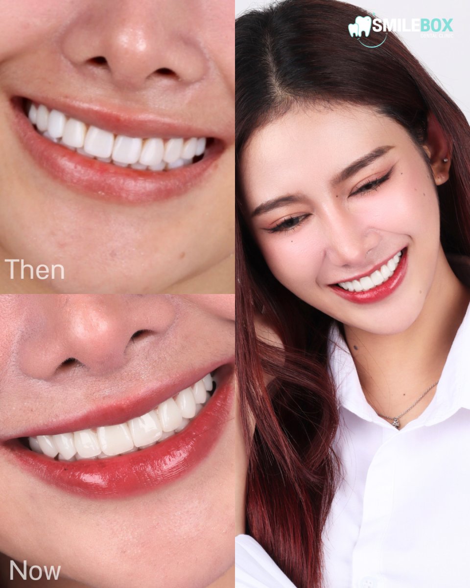 نتائج قبل وبعد عدسات الأسنان الخزفية في SmileBox Dental Clinic - Thonglor