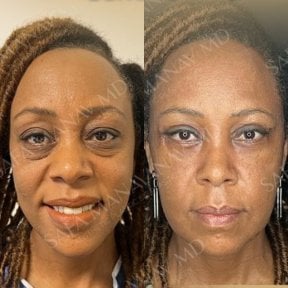 Vorher-nachher-Ergebnis Oberlidstraffung bei Dr. Safa Manav Clinic, verjüngte Augenpartie