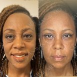 Vorher-nachher-Ergebnis Oberlidstraffung bei Dr. Safa Manav Clinic, verjüngte Augenpartie