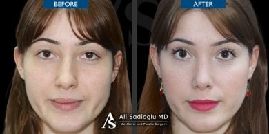 Vorher-nachher-Ergebnisse der Nasenkorrektur bei Dr. Safa Manav Clinic, Nasenformung Frau