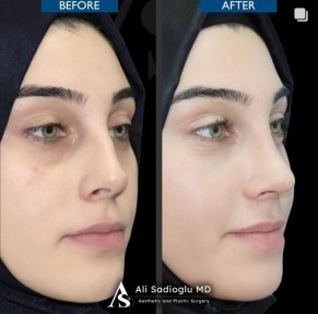 Vorher-nachher-Ergebnis der Nasenkorrektur bei Dr. Safa Manav Clinic, Nasenformung Frau