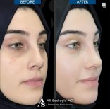 Vorher-nachher-Ergebnis der Nasenkorrektur bei Dr. Safa Manav Clinic, Nasenformung Frau