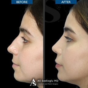 نتائج تجميل الأنف قبل وبعد في عيادة Dr. Safa Manav، إعادة تشكيل الأنف بشكل طبيعي