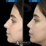 نتائج تجميل الأنف قبل وبعد في عيادة Dr. Safa Manav، إعادة تشكيل الأنف بشكل طبيعي