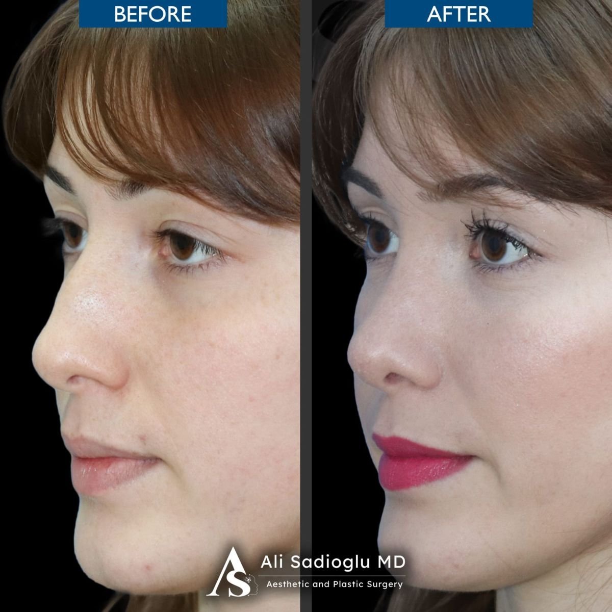 Vorher-nachher-Rhinoplastik-Ergebnis bei Dr. Safa Manav Clinic, verbesserte Nasenform